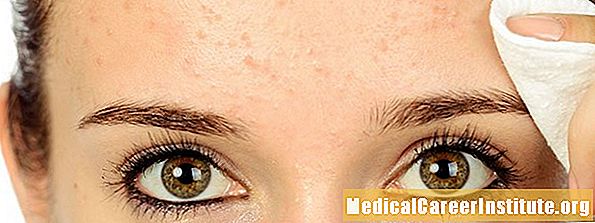 Akne (kviser) quiz: Test din medisinske IQ Akne (kviser) quiz: Test din medisinske IQ