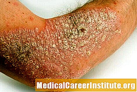 Brodalumab (Siliq)