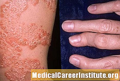 Mgbaàmà ọrịa ogbu na nkwonkwo nke Psoriatic, ọgwụgwọ, foto