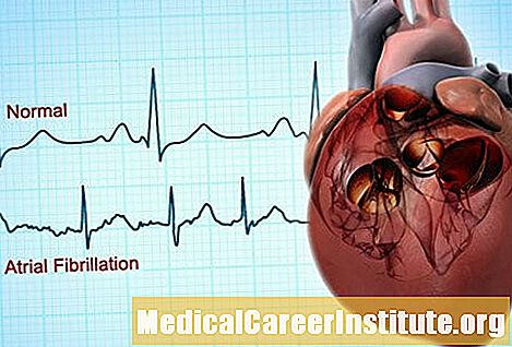 الرجفان الأذيني: أعراض القلب والتشخيص والعلاج - الطب وشك