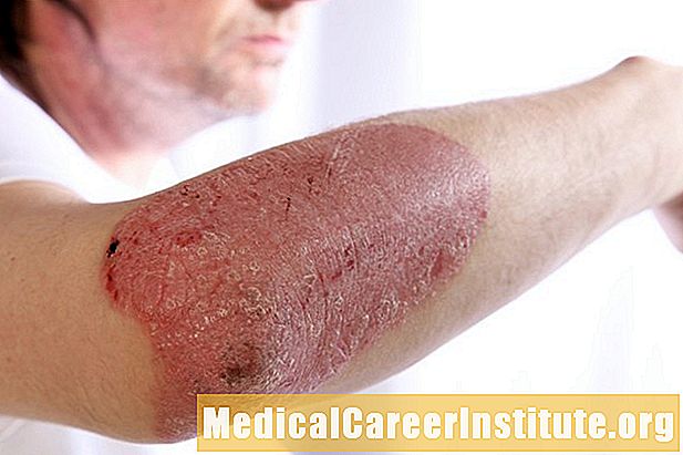 Kan psoriasis gå væk på egen hånd? Hvad sker der, hvis psoriasis ikke behandles?
