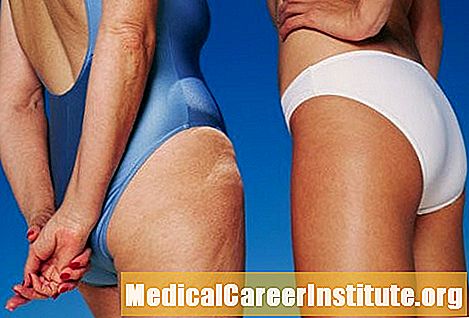 Fatti di cellulite e opzioni di trattamento
