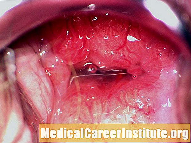 Cervicitis