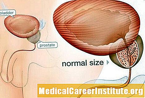 Padidėjusios prostatos (BPH) simptomai, diagnozė, gydymas - Apie Medicina
