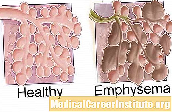 Sidee baad u qaaddaa emphysema?