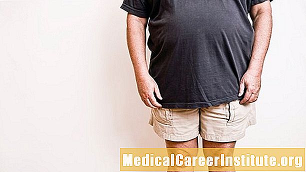 Az elhízás növelheti a fibromialgia kockázatát