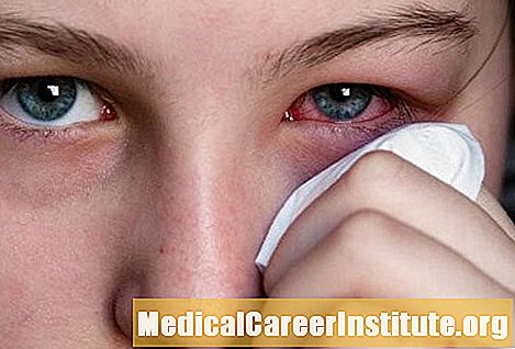 Różowe oko (zapalenie spojówek) Objawy, przyczyny, leczenie