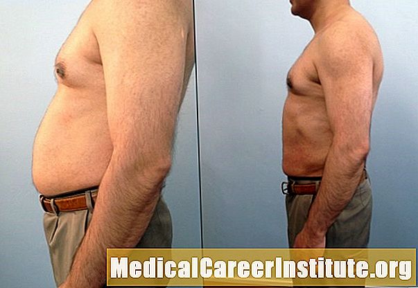 Sgrùdadh: Fat May Return After Liposuction