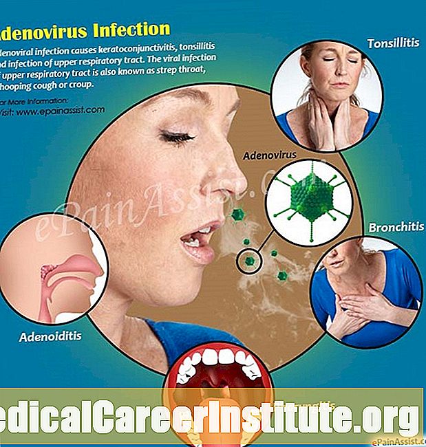 Adenovirüsün Belirtileri ve Belirtileri Adenovirüsün Belirtileri ve Belirtileri