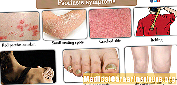 Symptomer og tegn på plakk psoriasis