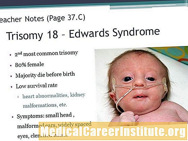 Trisomy 18 (Edwards Syndrome)