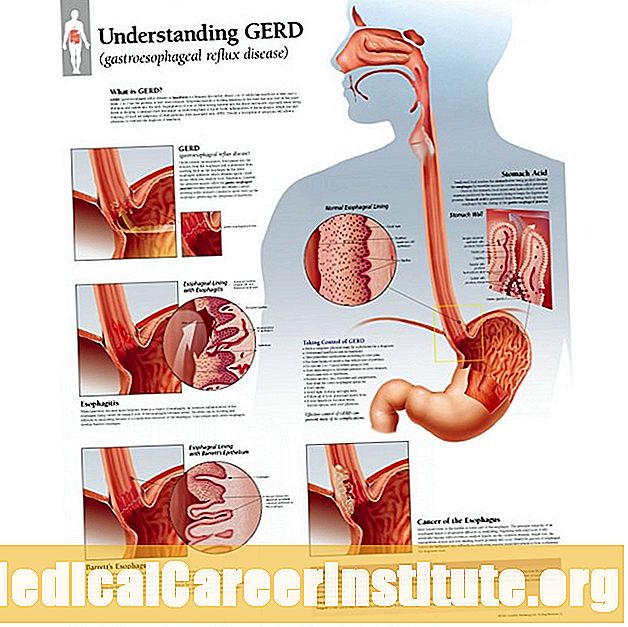 GERD جي علامات کي سمجھڻ