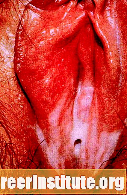 Secreción vaginal