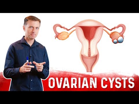 Ovariecyster: årsager, symptomer og naturlig behandling – Dr.Berg