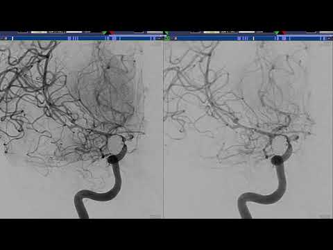 Intraarterial Treatment of Intracranial Vasospasm: Nimodipine
