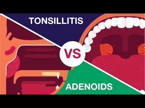 What is Adenoids and Tonsillitis? (Complete Video)