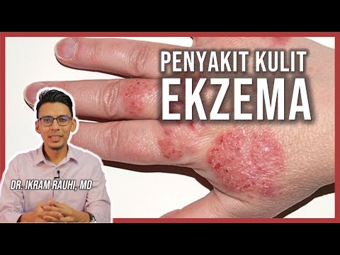Ekzema (Eczema) - Apa Yang Anda Patut Tahu : Punca dan Penyebab | Ubat Ekzema | Bayi dan Dewasa