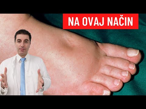 Kako izliječiti OTOK NOGU I RUKU (stopala, prstiju... ) te ostala zadržavanja tekućina u tijelu?
