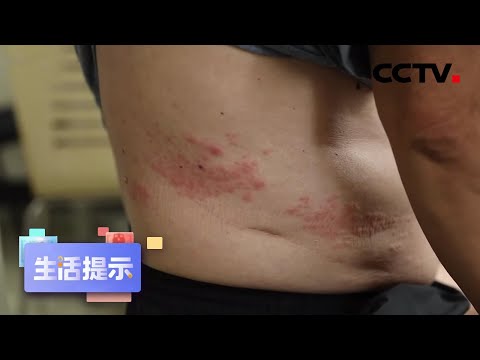 带状疱疹疫苗 需要接种吗？ | CCTV「生活提示」20200820