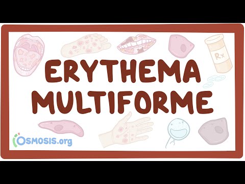 Erythema multiforme - årsager, symptomer, diagnose, behandling, patologi