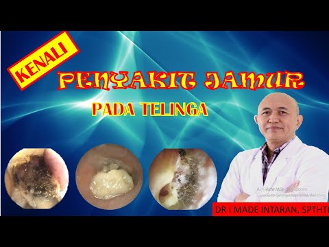 KENALI INFEKSI JAMUR PADA TELINGA